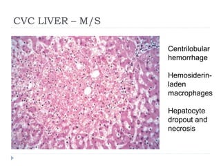 CVC LIVER – M/S
Centrilobular
hemorrhage
Hemosiderin-
laden
macrophages
Hepatocyte
dropout and
necrosis
 