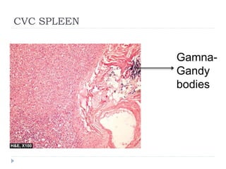 CVC SPLEEN
Gamna-
Gandy
bodies
 