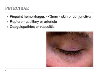 PETECHIAE
 Pinpoint hemorrhages - <3mm - skin or conjunctiva
 Rupture - capillary or arteriole
 Coagulopathies or vasculitis
 