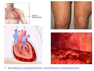 Hemothorax, hemopericardium, hemarthrosis, hemoperitoneum
 