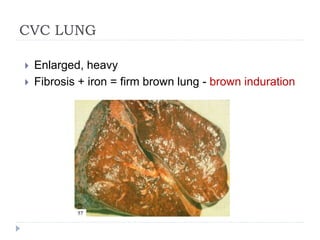 CVC LUNG
 Enlarged, heavy
 Fibrosis + iron = firm brown lung - brown induration
 