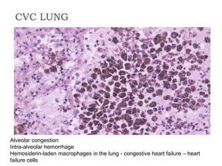 CVC LUNG
Alveolar congestion
Intra-alveolar hemorrhage
Hemosiderin-laden macrophages in the lung - congestive heart failure – heart
failure cells
 