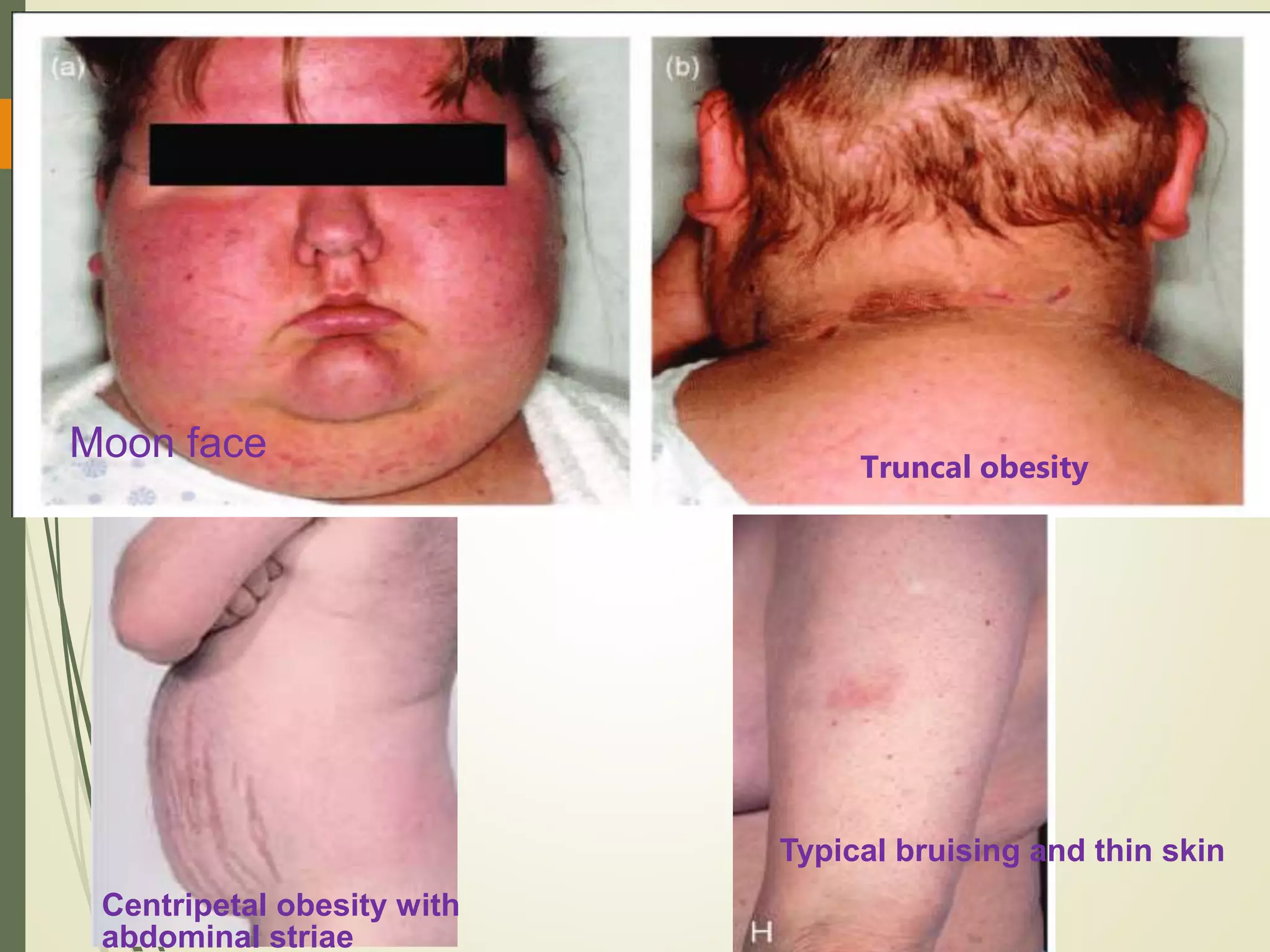 Moon face Truncal obesity
Centripetal obesity with
abdominal striae
Typical bruising and thin skin
 