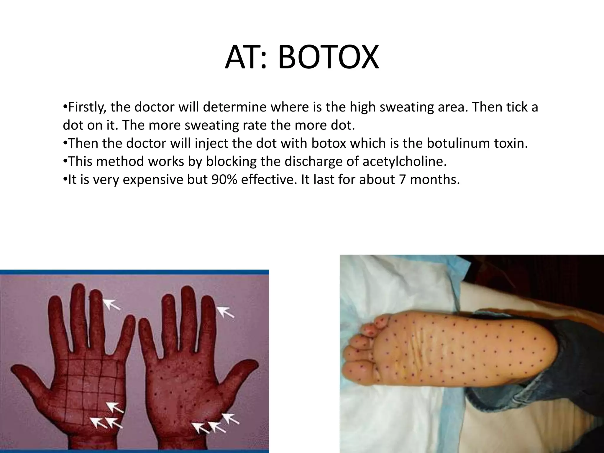 AT: BOTOX
•Firstly, the doctor will determine where is the high sweating area. Then tick a
dot on it. The more sweating rate the more dot.
•Then the doctor will inject the dot with botox which is the botulinum toxin.
•This method works by blocking the discharge of acetylcholine.
•It is very expensive but 90% effective. It last for about 7 months.

 