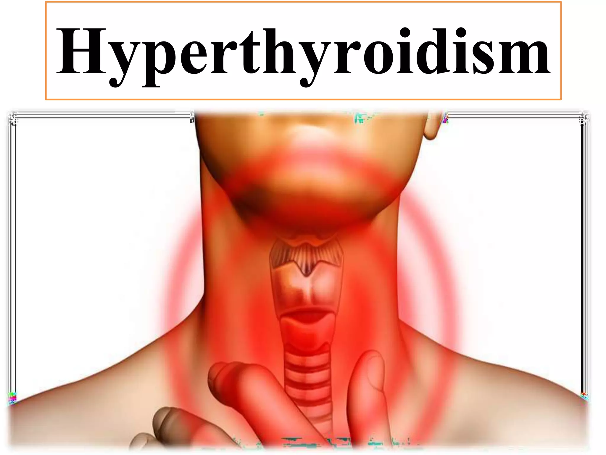 Hyperthyroidism
 
