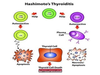 thyroid and parathyroid disorders | PDF