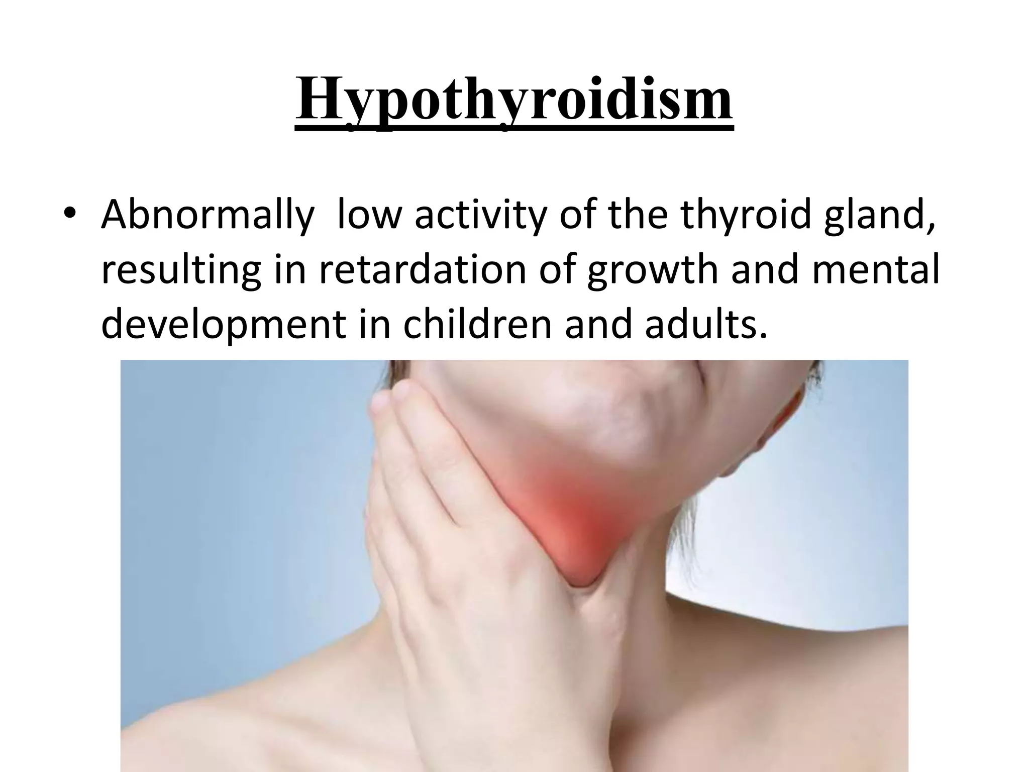 Hypothyroidism
• Abnormally low activity of the thyroid gland,
resulting in retardation of growth and mental
development in children and adults.
 