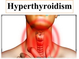 Hyperthyroidism
 