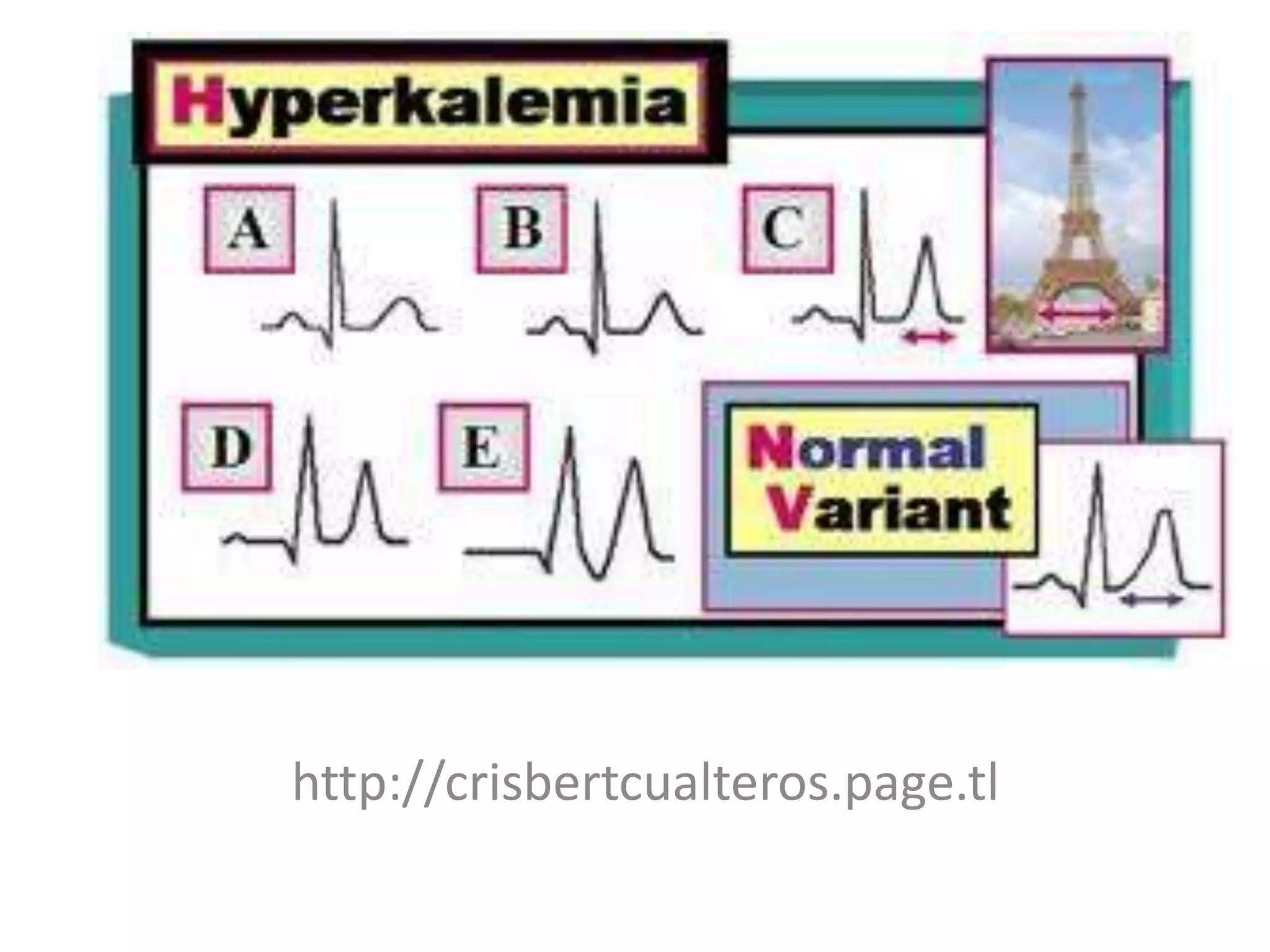 Hyperkalemia
http://crisbertcualteros.page.tl