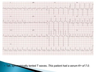 • Tall, symmetrically tented T waves. This patient had a serum K+ of 7.0.
 