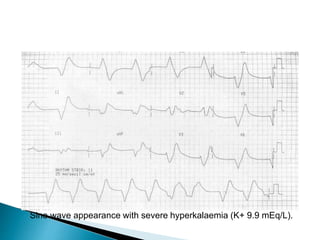Sine wave appearance with severe hyperkalaemia (K+ 9.9 mEq/L).
 