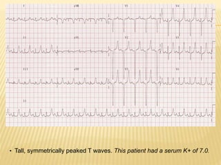 • Tall, symmetrically peaked T waves. This patient had a serum K+ of 7.0.
 