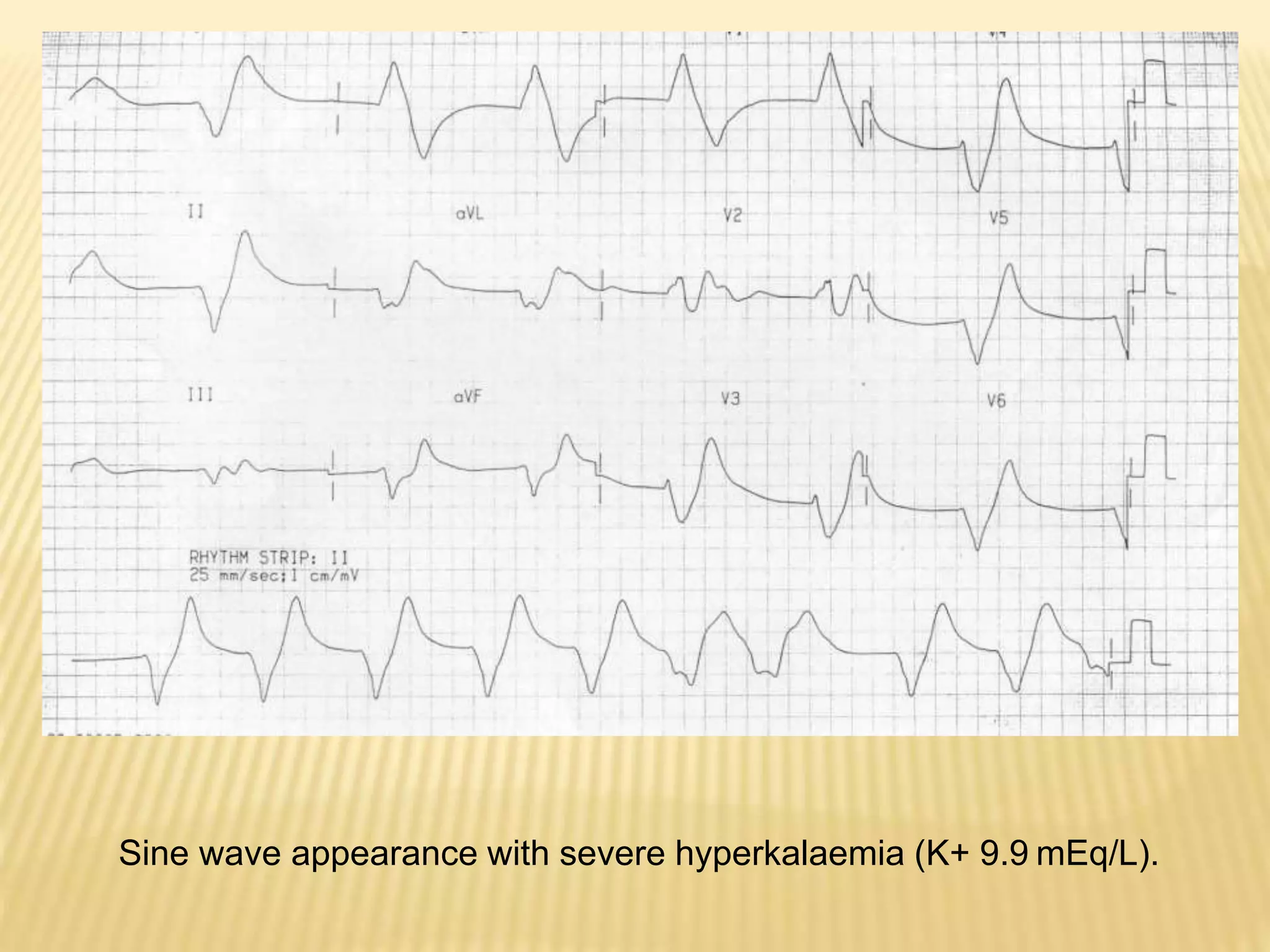 diagnosis-and-management-of-hyperkalemia-pptx