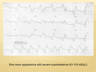 Sine wave appearance with severe hyperkalaemia (K+ 9.9 mEq/L).
 