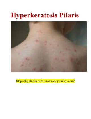 Hyperkeratosis Pilaris
http://kpchickenskin.manageyourkp.com/
 