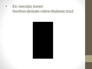 • Ex: vascular, tumor
Involvesdentato-rubro-thalamictract
 