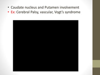 • Caudate nucleus and Putamen involvement
• Ex: Cerebral Palsy, vascular, Vogt’s syndrome
 
