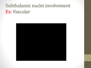 Subthalamic nuclei involvement
Ex: Vascular
 