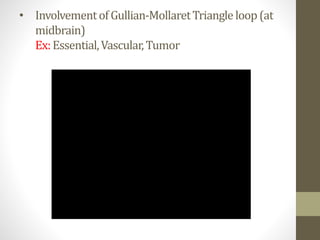• InvolvementofGullian-MollaretTriangleloop(at
midbrain)
Ex:Essential,Vascular,Tumor
 