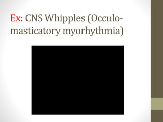 Ex: CNS Whipples (Occulo-
masticatory myorhythmia)
 