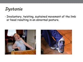 Dystonia
• Involuntary, twisting, sustained movement of the limb
or head resulting in an abnormal posture.
 