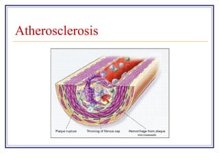 Atherosclerosis
 