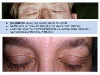 1. Xanthelasmas: nodular lipid deposits around the eyelids
2. Typically bilateral, yellow, flat plaques on the upper eyelids (nasal side)
3. Occurrence: primary or hypercholesterolemia (e.g., primary biliary cholangitis),
hyperapobetalipoproteinemia, ↑ LDL level
 