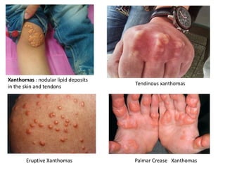 Eruptive Xanthomas Palmar Crease Xanthomas
Tendinous xanthomas
Xanthomas : nodular lipid deposits
in the skin and tendons
 