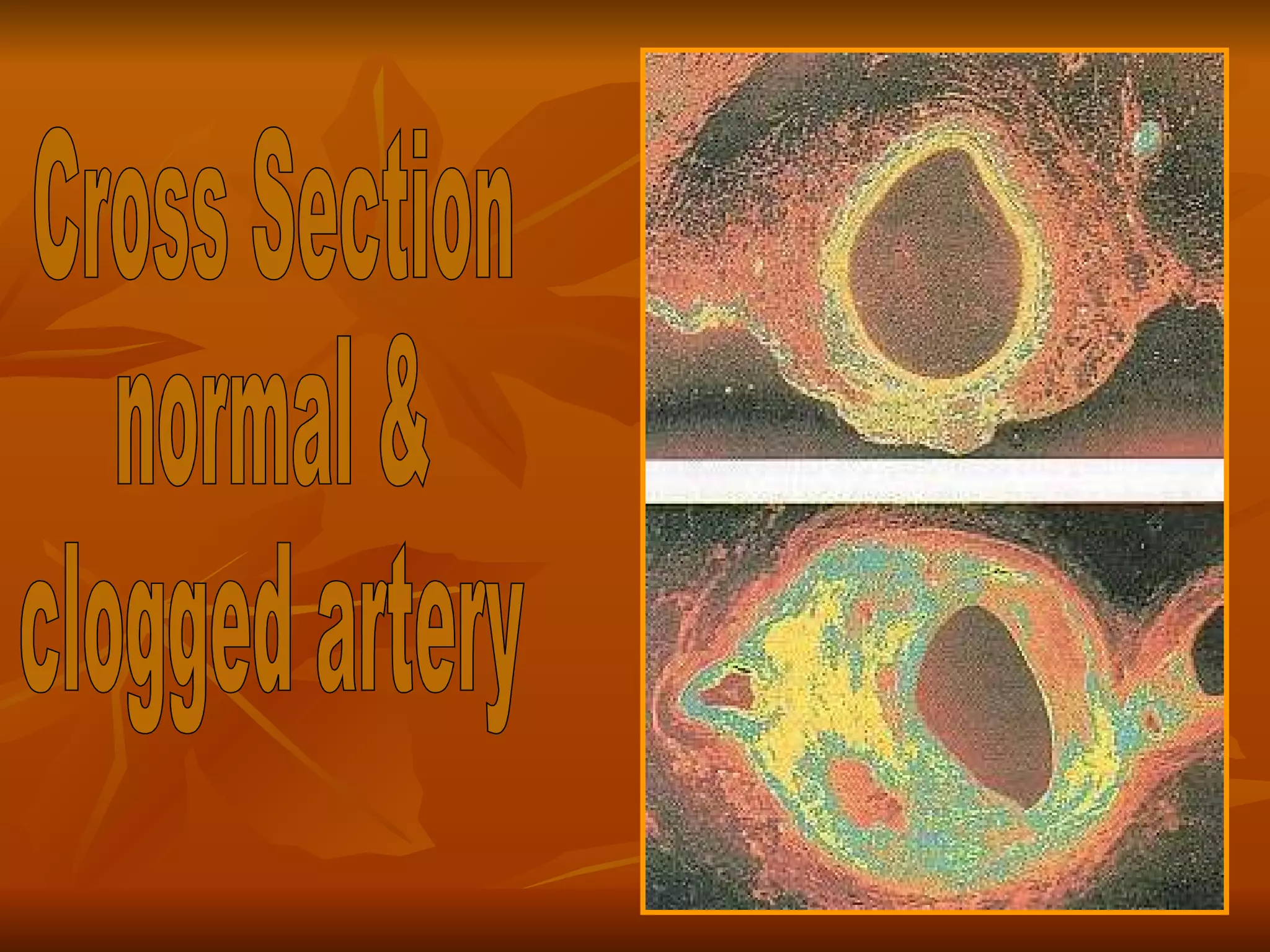 Cross Section normal &  clogged artery 