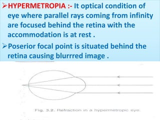 HYPERMETROPIA :- It optical condition of
eye where parallel rays coming from infinity
are focused behind the retina with the
accommodation is at rest .
Poserior focal point is situated behind the
retina causing blurrred image .
 