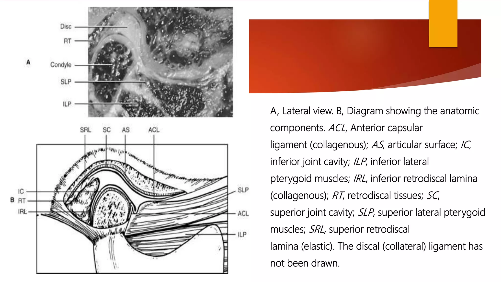 A, Lateral view. B, Diagram showing the anatomic
components. ACL, Anterior capsular
ligament (collagenous); AS, articular surface; IC,
inferior joint cavity; ILP, inferior lateral
pterygoid muscles; IRL, inferior retrodiscal lamina
(collagenous); RT, retrodiscal tissues; SC,
superior joint cavity; SLP, superior lateral pterygoid
muscles; SRL, superior retrodiscal
lamina (elastic). The discal (collateral) ligament has
not been drawn.
 
