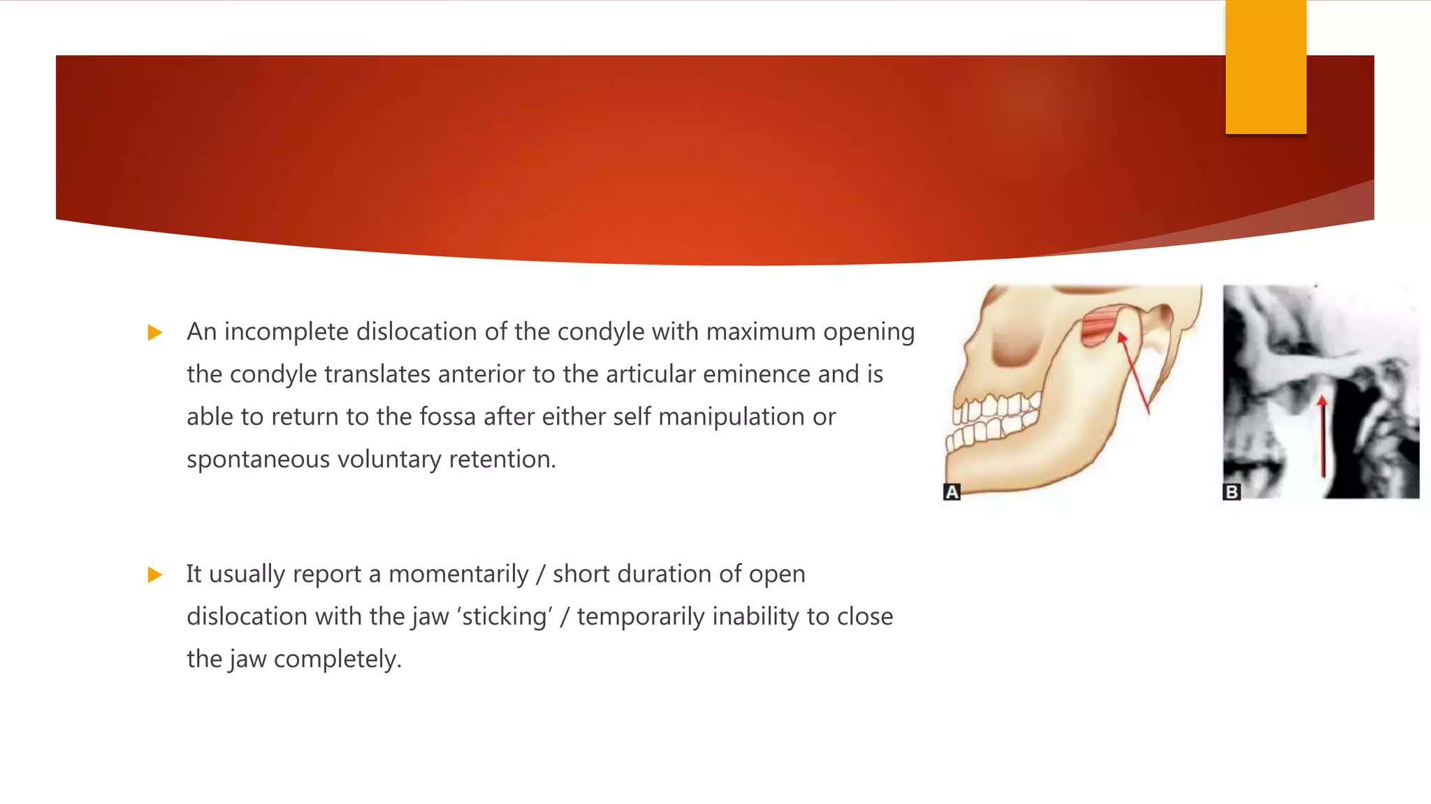  An incomplete dislocation of the condyle with maximum opening
the condyle translates anterior to the articular eminence and is
able to return to the fossa after either self manipulation or
spontaneous voluntary retention.
 It usually report a momentarily / short duration of open
dislocation with the jaw ‘sticking’ / temporarily inability to close
the jaw completely.
 