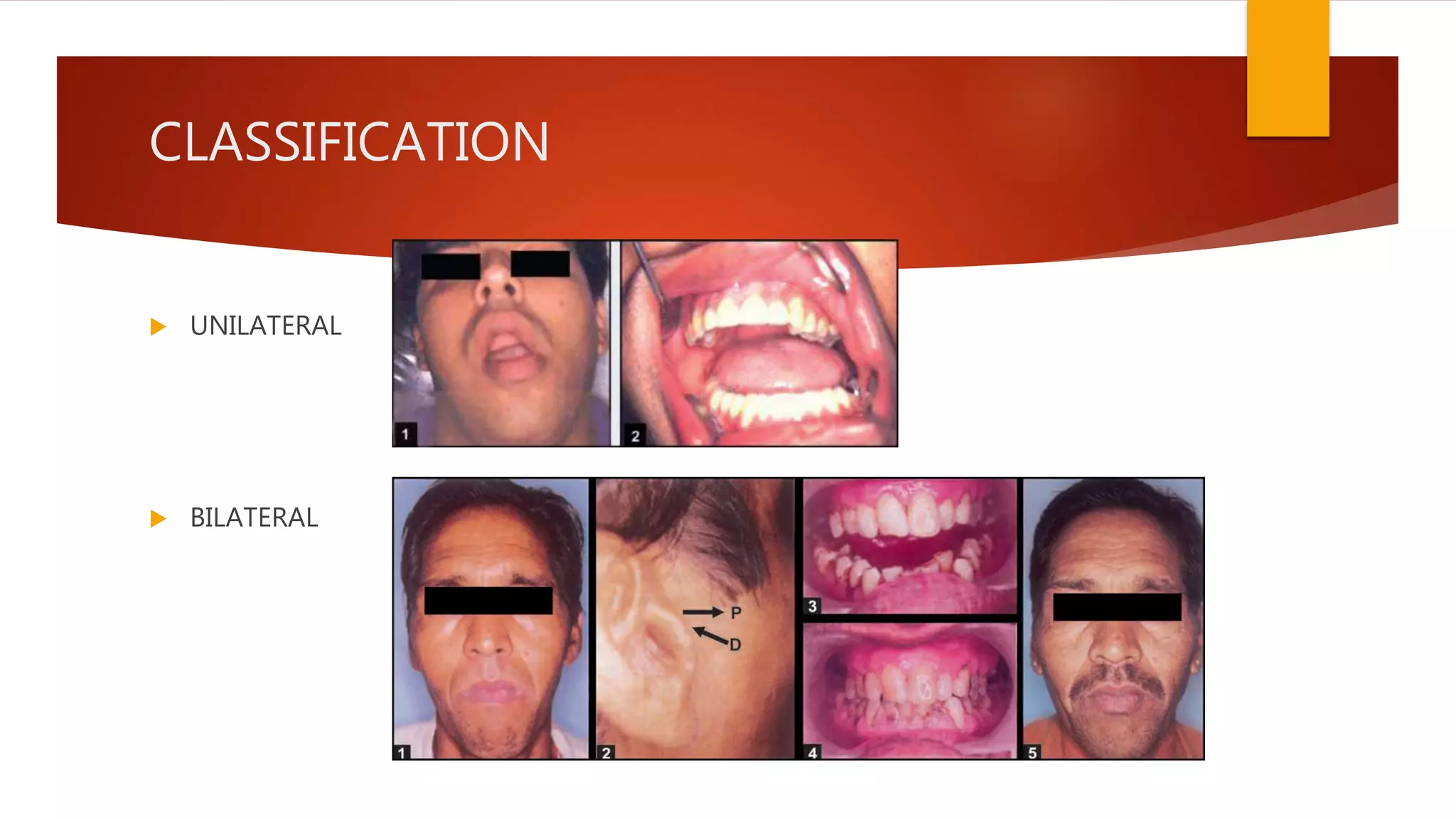 CLASSIFICATION
 UNILATERAL
 BILATERAL
 