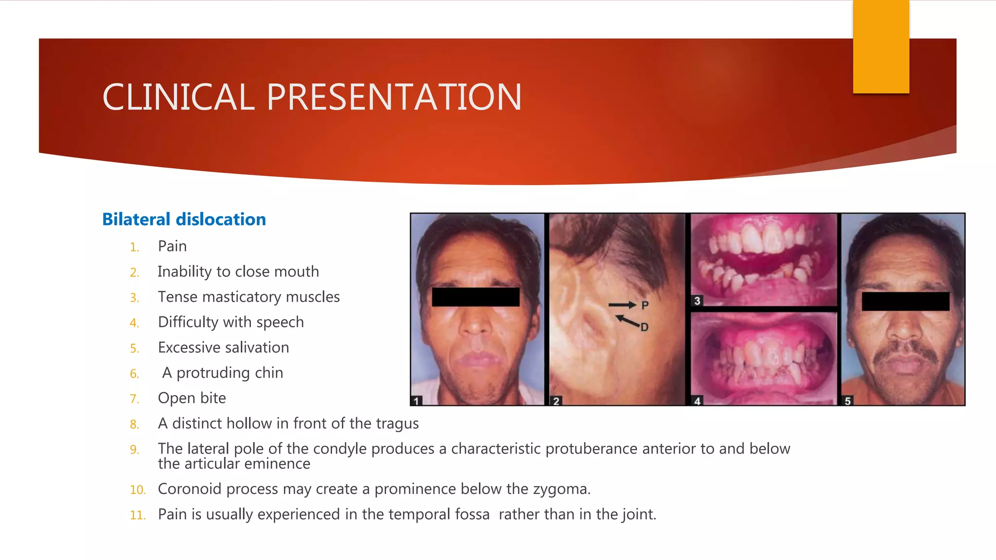 CLINICAL PRESENTATION
Bilateral dislocation
1. Pain
2. Inability to close mouth
3. Tense masticatory muscles
4. Difficulty with speech
5. Excessive salivation
6. A protruding chin
7. Open bite
8. A distinct hollow in front of the tragus
9. The lateral pole of the condyle produces a characteristic protuberance anterior to and below
the articular eminence
10. Coronoid process may create a prominence below the zygoma.
11. Pain is usually experienced in the temporal fossa rather than in the joint.
 
