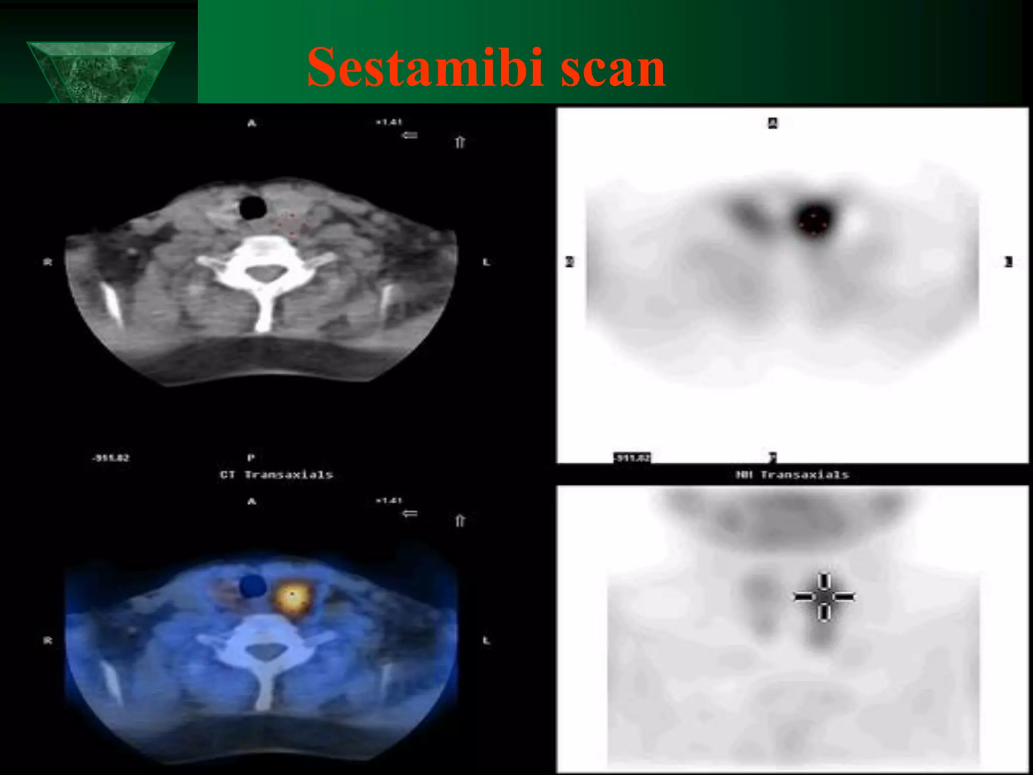 Sestamibi scan
 