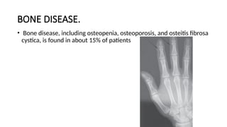 BONE DISEASE.
• Bone disease, including osteopenia, osteoporosis, and osteitis fibrosa
cystica, is found in about 15% of patients
 