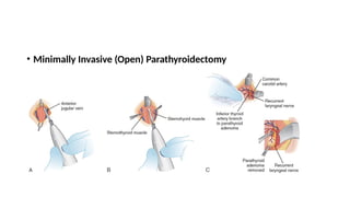 • Minimally Invasive (Open) Parathyroidectomy
 
