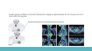 • Single injection of 99mTc sestamibi, followed by imaging at approximately 10–15 minutes and 1.5–3
hours after the injection.
• Parathyroid adenoma showing delayed washout.
SPECT
 