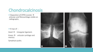 ➢Deposition of CPPD crystals 
articular and fibrocartilage visible on
radiographs.
➢X rays of :
Hand  triangular ligament.
Knees  articular cartilage and
menisci.
Symphysis pubis.
 