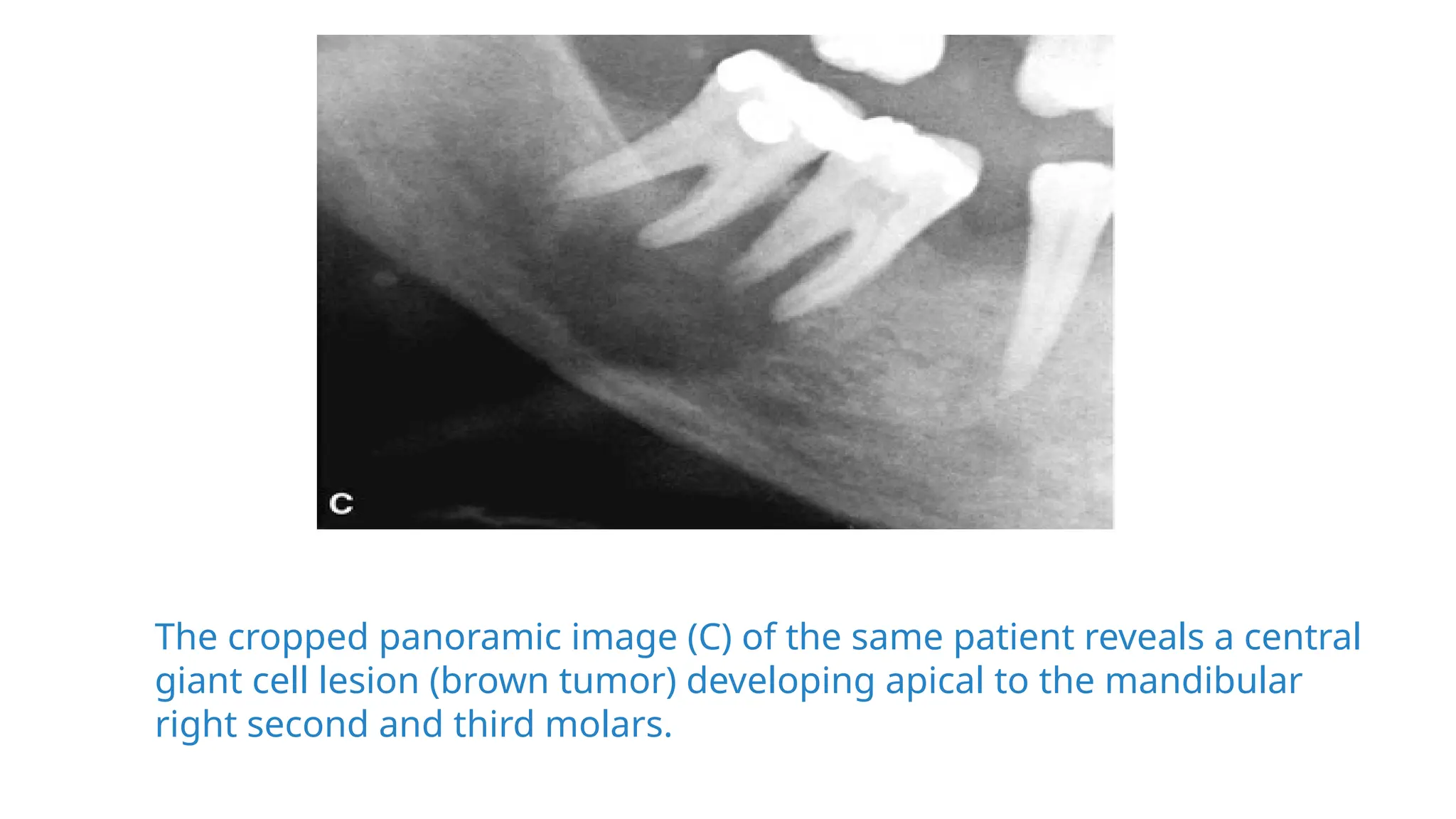 hyperparathyroidism , it's effects on jaws and teeth | PPTX
