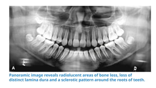 hyperparathyroidism , it's effects on jaws and teeth | PPTX