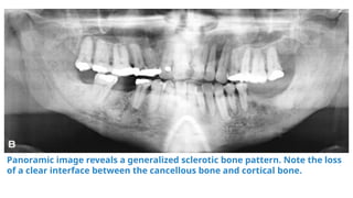 hyperparathyroidism , it's effects on jaws and teeth | PPTX