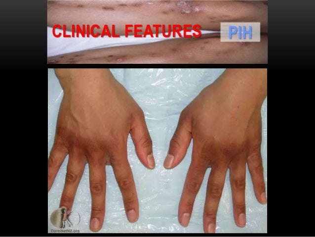 Disorders of Hyperpigmentation