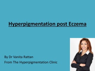 Hyperpigmentation post Eczema 
By Dr Vanita Rattan 
From The Hyperpigmentation Clinic 
 
