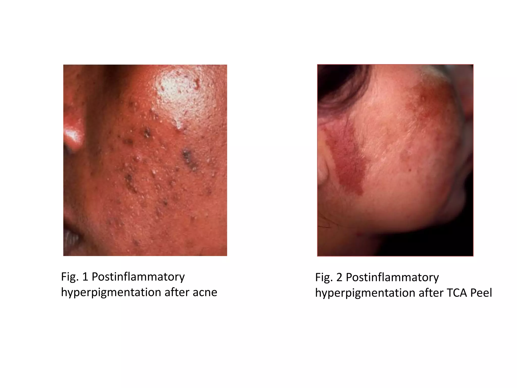 Fig. 1 Postinflammatory
hyperpigmentation after acne
Fig. 2 Postinflammatory
hyperpigmentation after TCA Peel
 