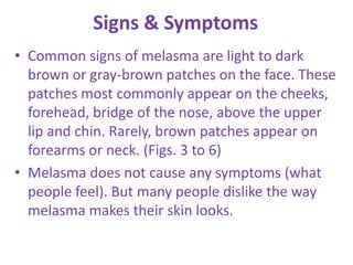 Signs & Symptoms
• Common signs of melasma are light to dark
brown or gray-brown patches on the face. These
patches most commonly appear on the cheeks,
forehead, bridge of the nose, above the upper
lip and chin. Rarely, brown patches appear on
forearms or neck. (Figs. 3 to 6)
• Melasma does not cause any symptoms (what
people feel). But many people dislike the way
melasma makes their skin looks.
 