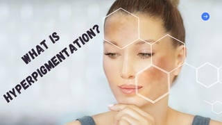 WHAT
IS
HYPERPIGMENTATION?
 