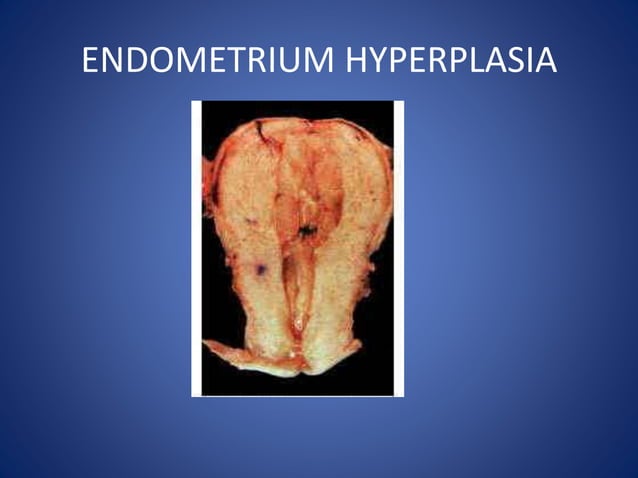 Hyperplasia | PPTX | Endocrine and Metabolic Diseases | Diseases and ...