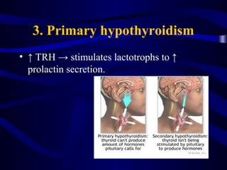 3. Primary hypothyroidism
• ↑ TRH → stimulates lactotrophs to ↑
prolactin secretion.
 