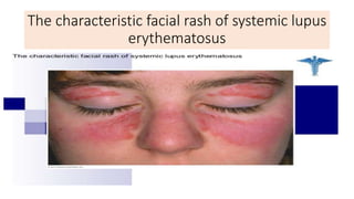 The characteristic facial rash of systemic lupus
erythematosus
 